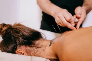 Persona recibiendo tratamiento de acupuntura, una práctica que busca equilibrar el flujo de energía vital, o chi, a través de la inserción de agujas en puntos específicos del cuerpo. 